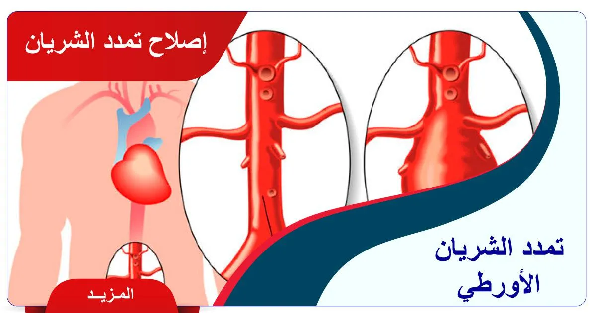 إصلاح تمدد الشريان الأورطي